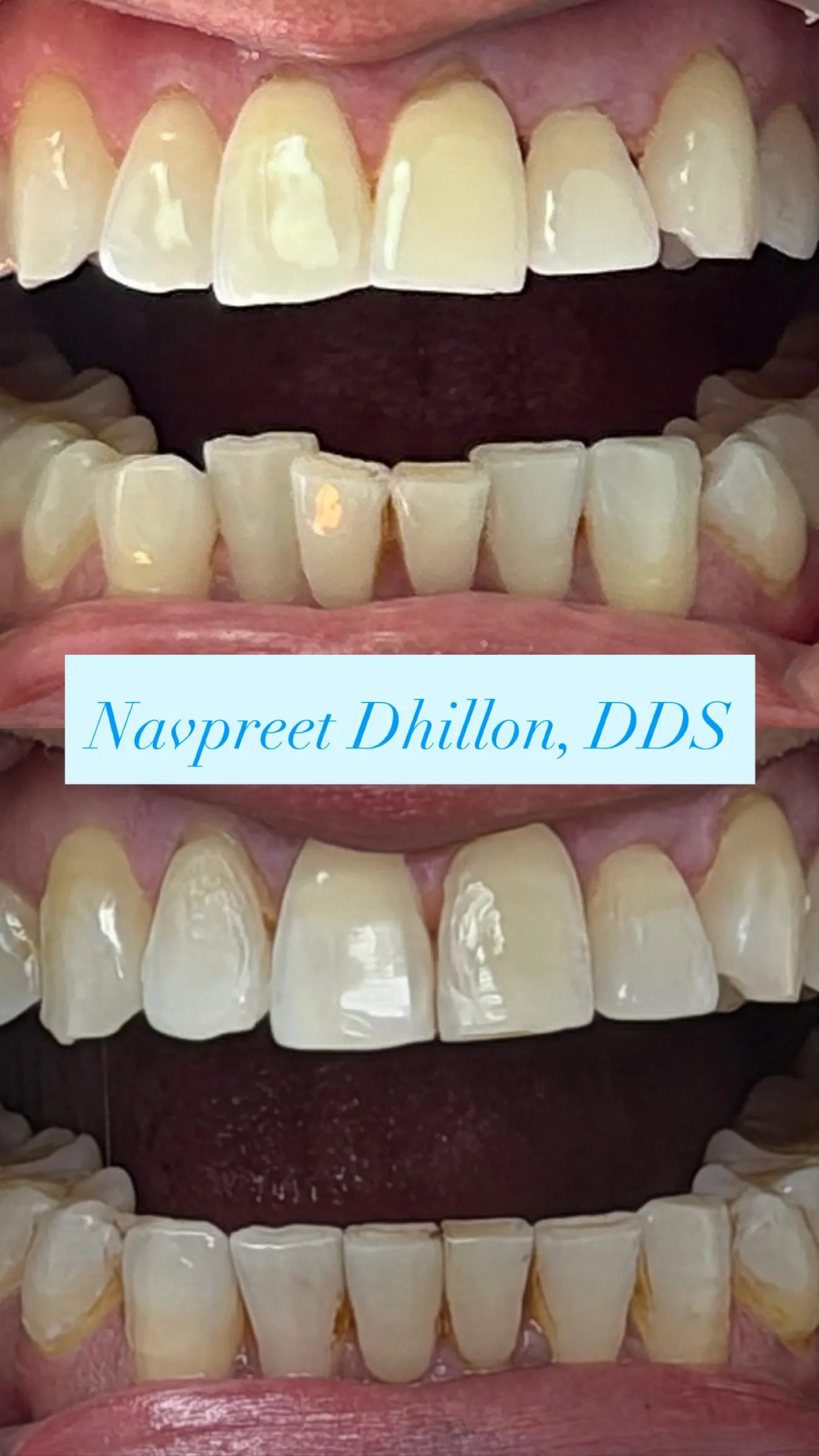 Invisalign Result