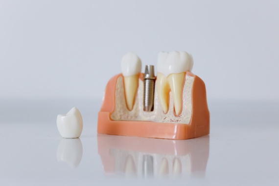 Dental Implants in Manassas