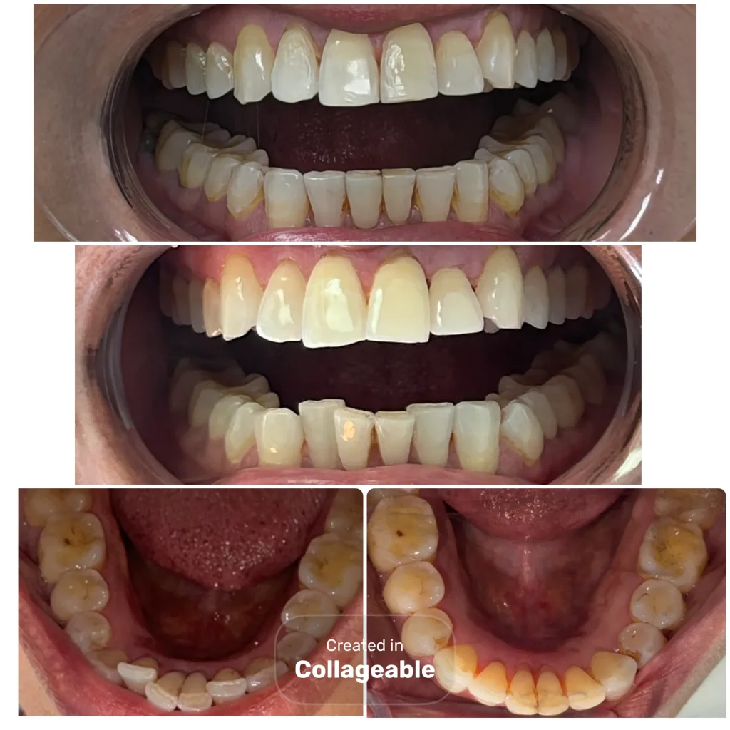 Invisalign Result
