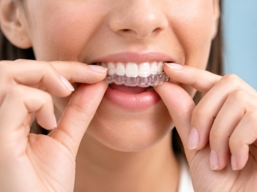 Invisalign Aligners in Manassas
